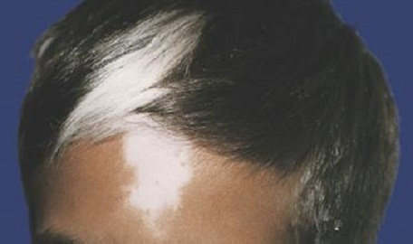 白癜风病症状科普系列：白癜风毛发变白是为什么